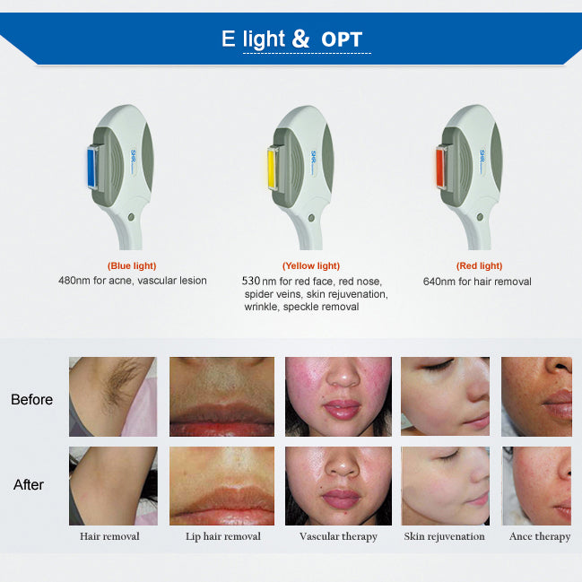 جهاز OPT-01 متعدد الوظائف – تجديد البشرة وإزالة الشعر بتقنية IPL و SHR