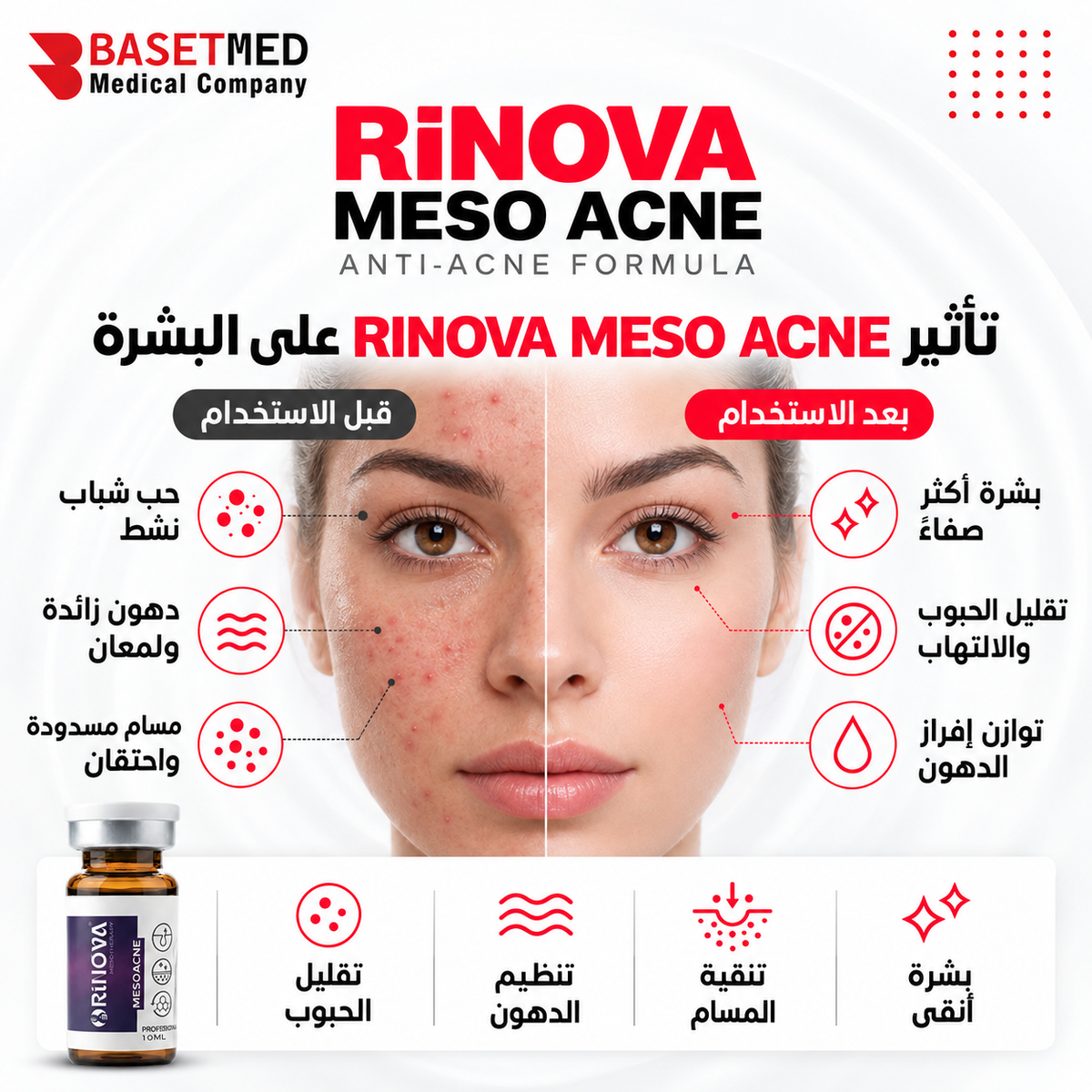Rinova Meso Acne ||1305